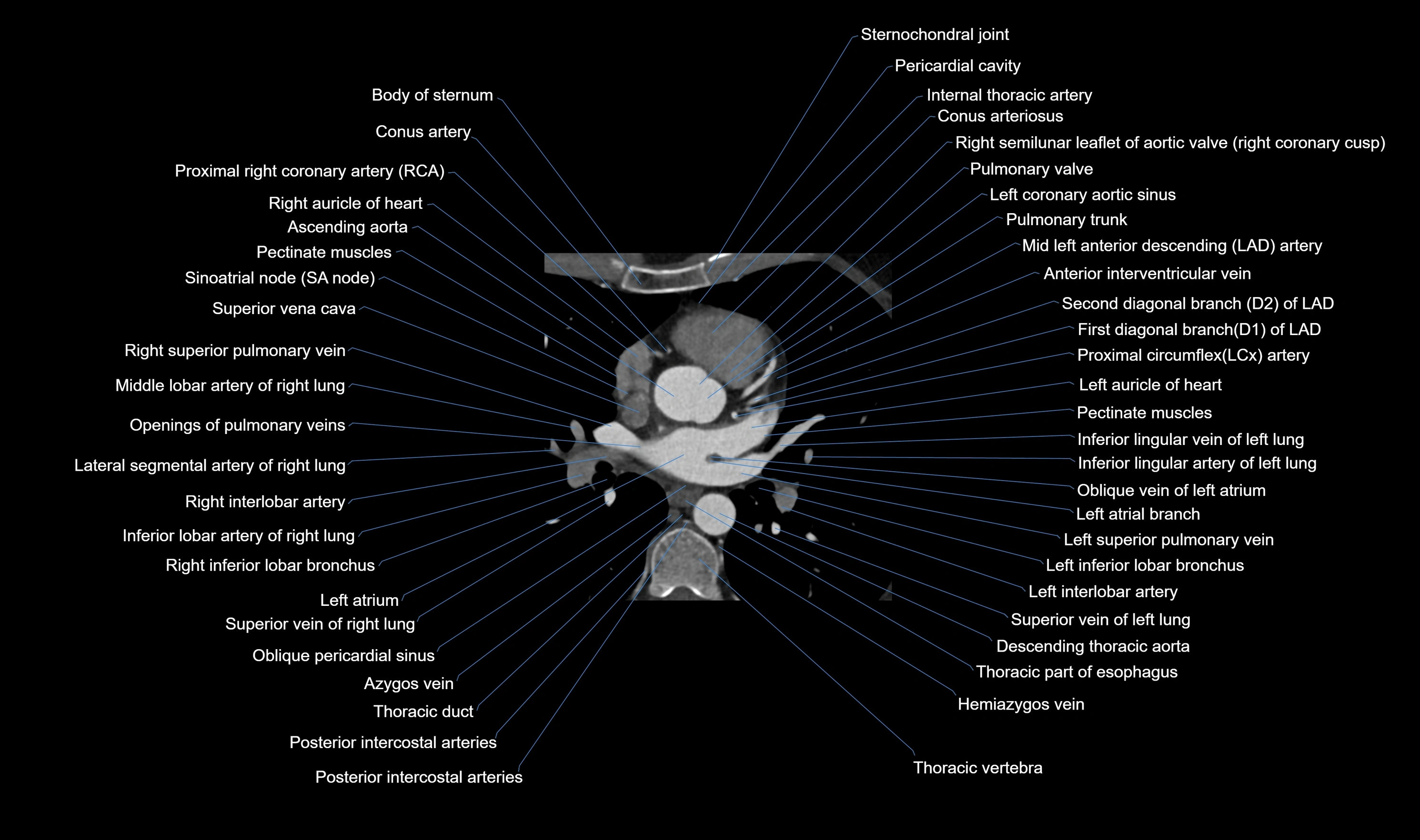 CT heart (coronary angiogram) axial view cross sectional anatomy labelled radiology image-00023.webp